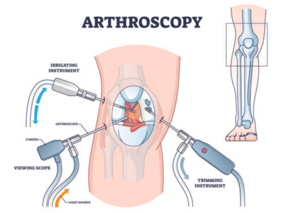 Arthroscopy - White Lotus Hospital