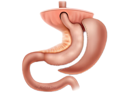 Bariatric Surgery
