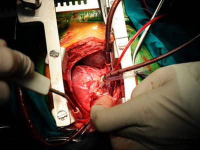 Cardiac Surgery Support