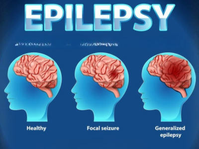 Epilepsy