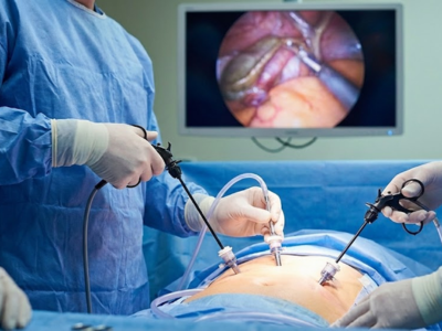 Gallbladder Surgery (Cholecystectomy)