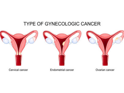 Gynecological Cancers
