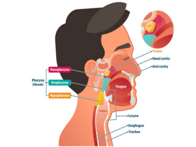Head and Neck Cancers