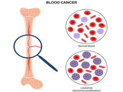 Hematological Cancers