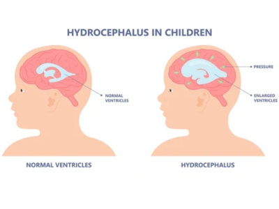 Hydrocephalus