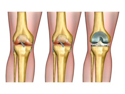 Joint Replacement Surgery - White Lotus Hospital