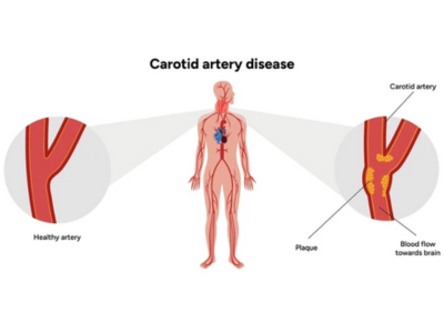 Neurovascular Surgery - White Lotus Hospital