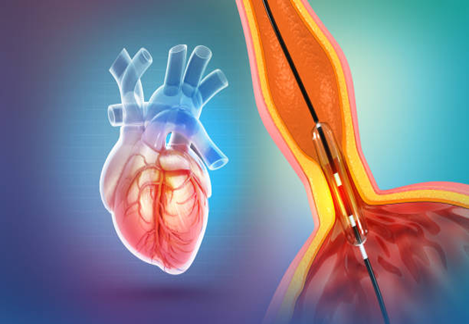 Interventional Cardiology