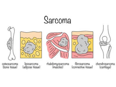 Skin and Soft Tissue Cancers