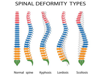 Spinal Disorders