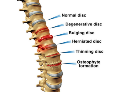 Spinal Disorders