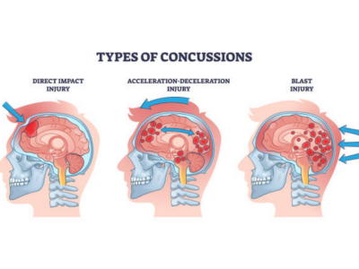 Traumatic Brain Injuries